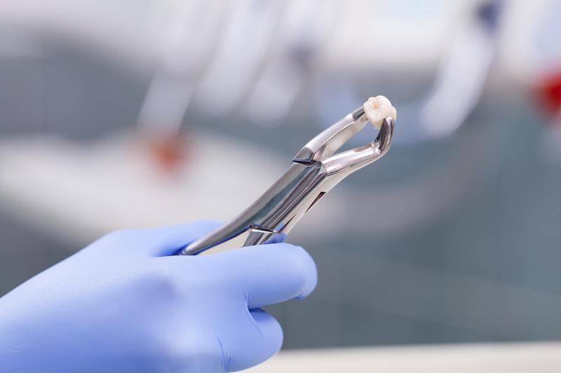 tooth extraction  Vacaville, CA, 